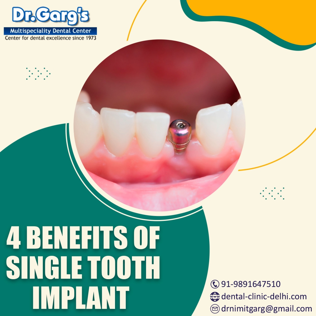 single tooth implant