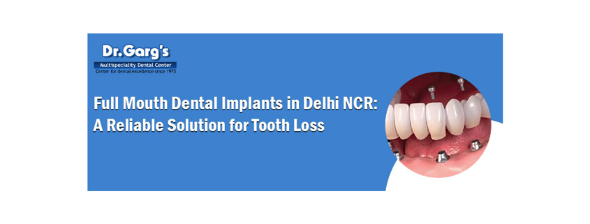 Full Mouth Dental Implants in Delhi NCR