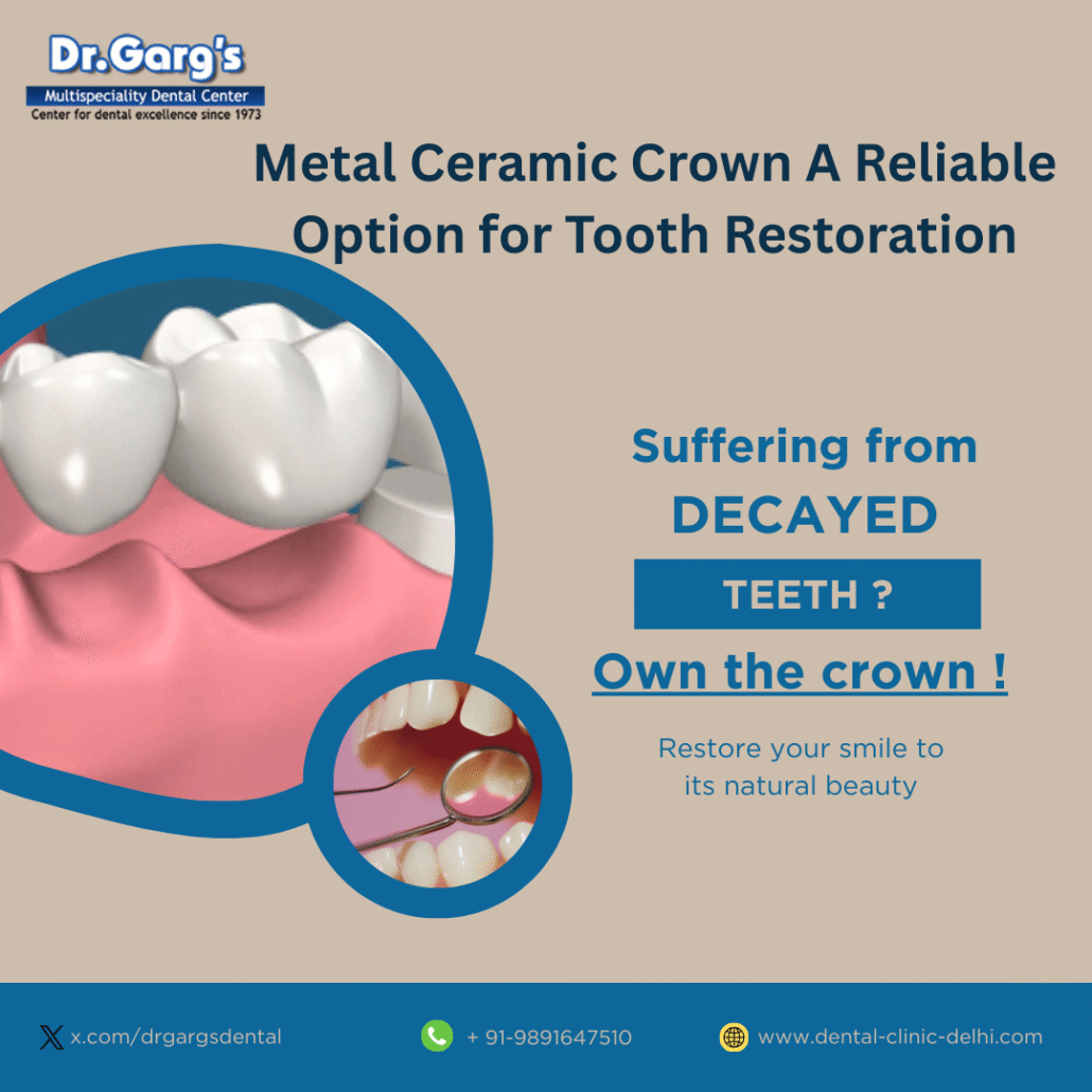 It is commonly known as a metal ceramic tooth cap or porcelain fused to metal crown.
